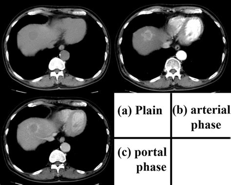 The Contrast Enhanced Computed Tomography Scan Obtained On Admission