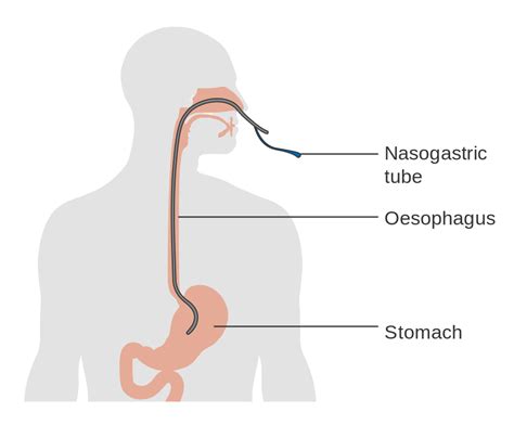 Filediagram Showing The Position Of A Nasogastric Tube Cruk 340svg