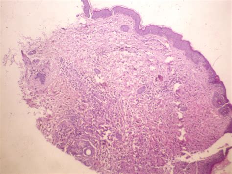 Langerhans Cell Histiocytosis Histology