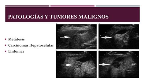 Patologías hepaticas pptx Patologías hepaticas pptx