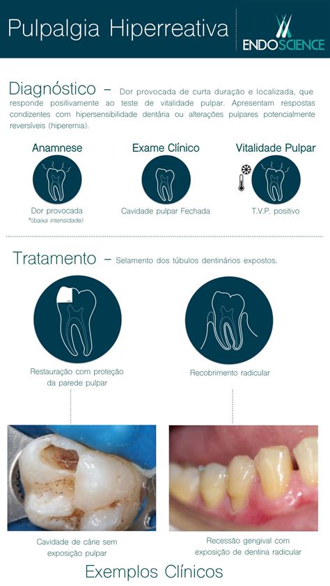 Pulpalgia Hiperreativa Endoscience