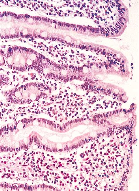 Duodenal Biopsy Specimen Showing Villous Blunting And A Dense