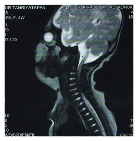 On The Cervical Spinal Mri Spinal Stenosis At C C And C