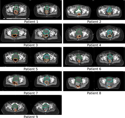 Representative Axial Slices From Planning Ct Left And Repeated Ct