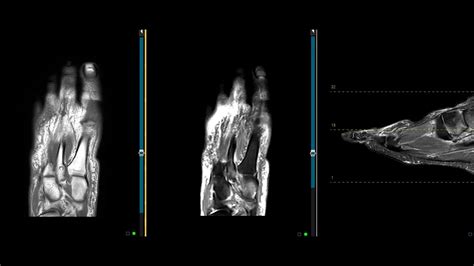 Lisfranc Ligament Tear And Navicular Fracture YouTube