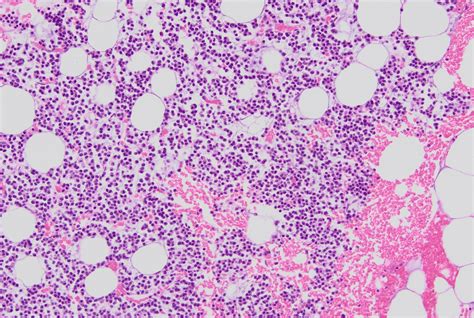 Pathology Outlines Plasma Cell Myeloma Multiple Myeloma