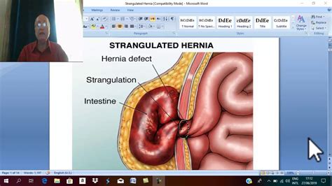 Hernia In English 5 Strangulated Hernia Part 1 By Dr Wahdan