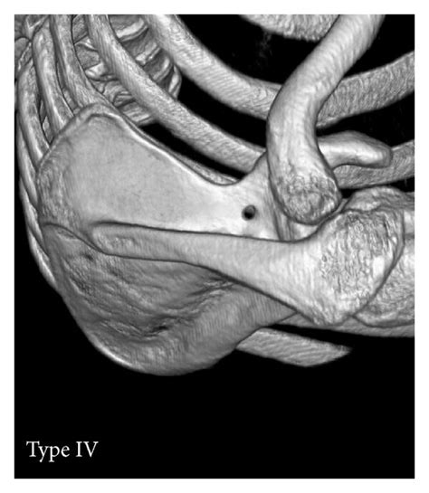 Types Iv V Of The Suprascapular Notch Three Dimensional Volume