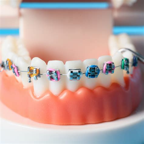 Orthognathic Orthodontic Treatment TDC TURKISH DENTAL CENTRE