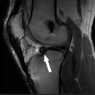 Pdf Mri Findings Of Cyclops Lesions Of The Knee