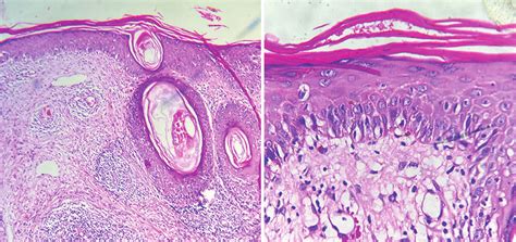 A Focal Epidermal Thinning And Basal Cell Vacuolization Smudged