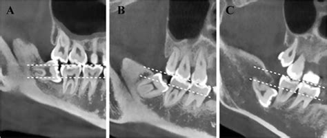 pell gregory classification  impacted mandibular  molars