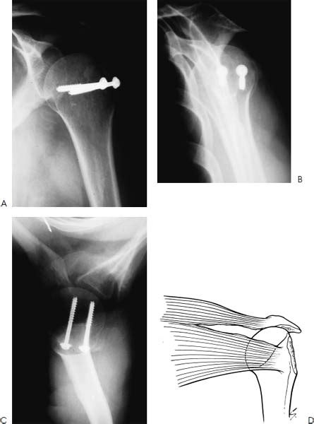 1. Greater Tuberosity Fracture | Musculoskeletal Key