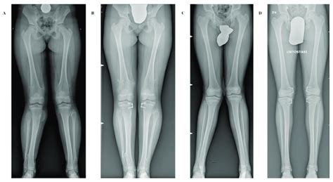 Long Standing Anteroposterior Radiographs Showing Two Representative