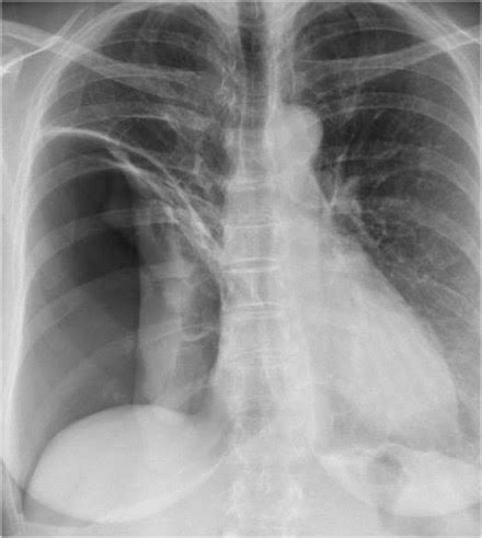 Chest Medicine Made Easy Dr Deepu Basics Of Chest X Ray Part The