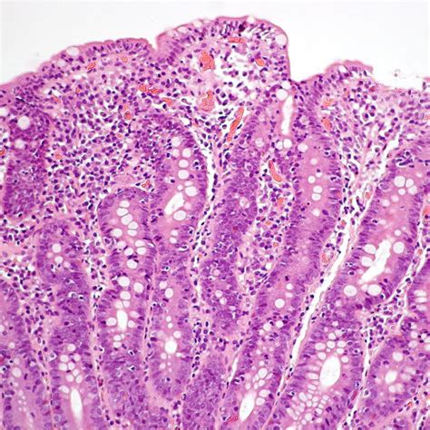 Representative Duodenal Endoscopic Picture Showing Decreased Mucosal