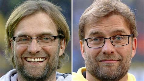 Haartransplantation Jürgen Klopp du hast Haare schön