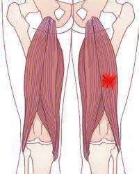 Commonplace Treatment For A Quad Strain Muscle Pull Muscle Pull