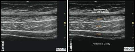 Ilioinguinal Nerve Block Ultrasound