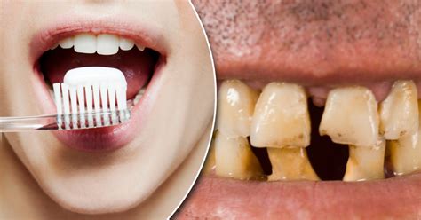 British People Have Some Of The Worst Teeth On Earth Tv Doctor Claims