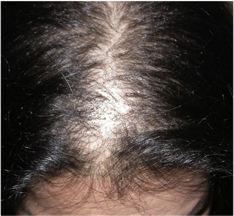 Alopecia Kids Are Not Just Little People Clinics In Dermatology