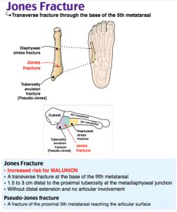 Fifth Metatarsal Fracture Treatment And Tips Metatarsal Fractures