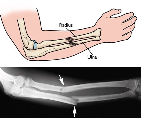 Radius Fracture — Miami Bone And Joint Institute Premier Center For Upper And Lower Extremity