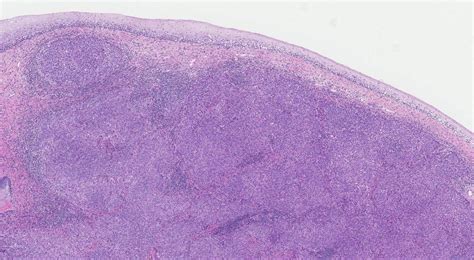 Squamous Cell Carcinoma Of The Cervix Ottawa Atlas Of Pathology