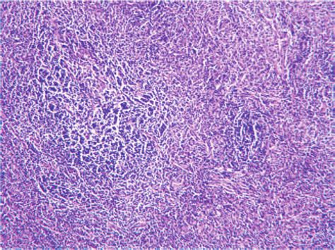 Spindle Shaped Tumor Cells Form A Whorled Growth Pattern H E