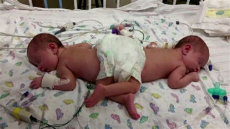 Surgery Separates Infant Conjoined Twins In Texas 6abc Philadelphia