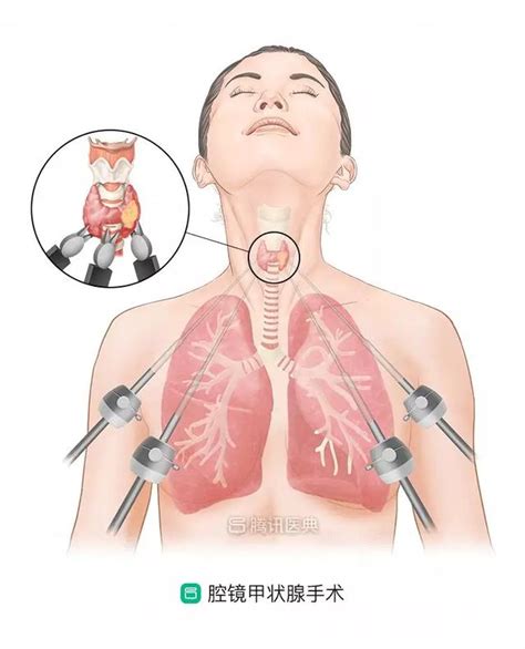 確診甲狀腺癌，能選擇腔鏡手術嗎？ 每日頭條