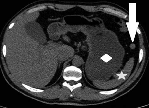 Ct Scan Of Accessory Spleen At The Gastrosplenic Ligament Accessory Download Scientific