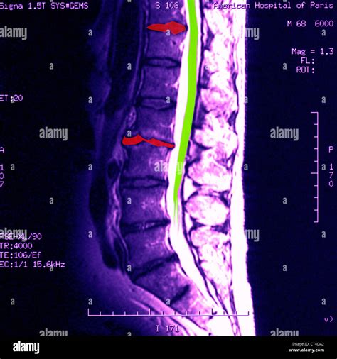 L'Arthrose vertébrale, IRM Photo Stock - Alamy