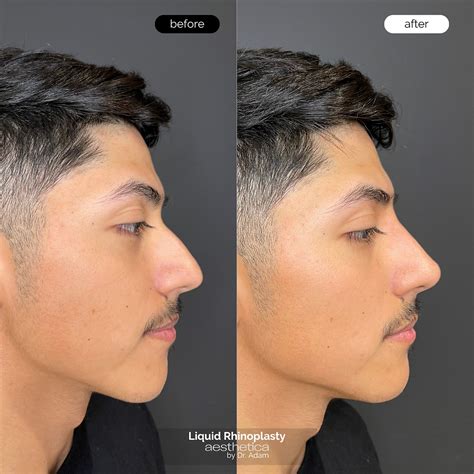 How Long Does Liquid Rhinoplasty Last And What Is The Recovery Time Like