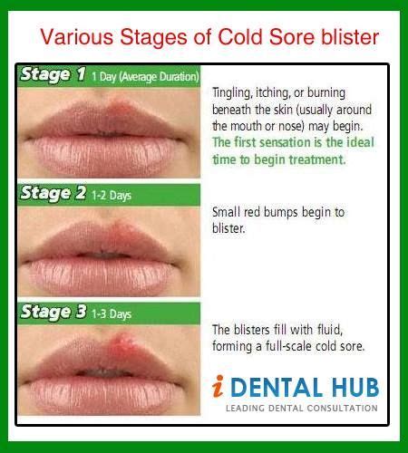 Various Stages Cold Sore Blister Cold Sore Treatment Cold Sore Stages Cold Sore