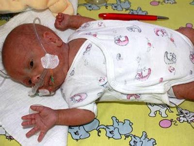 Runjun Blog: World's Smallest Baby Boy Survives