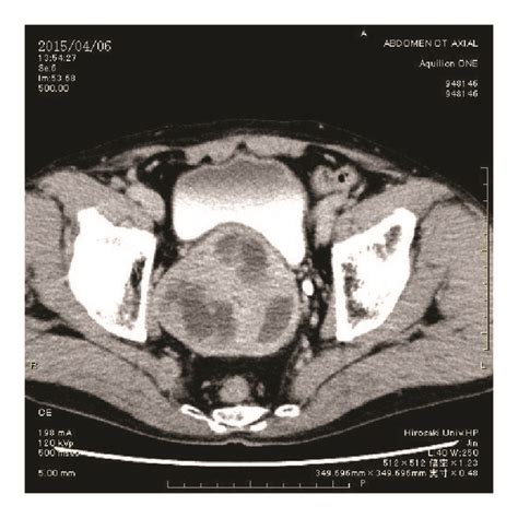 Ct Scan Image Of Prostatic Tumor A Axial Image B Sagittal Image