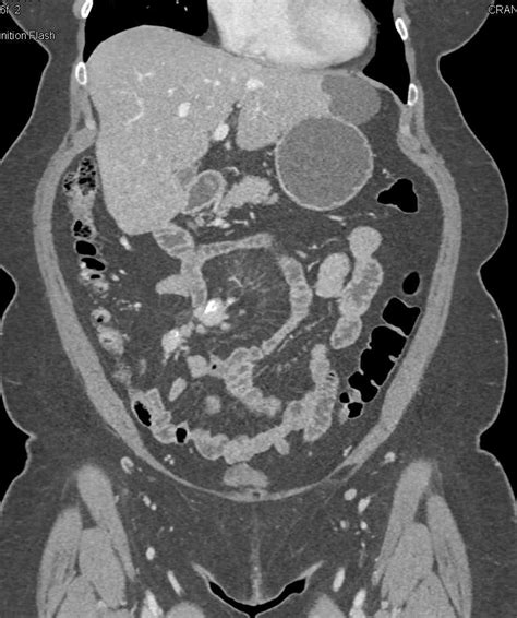 Carcinoid Tumor Root Of Mesentery With Desmoplastic Reaction Small