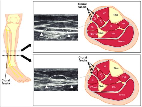 llustrations of superficial peroneal nerve (SPN) anatomy at crural... | Download Scientific Diagram