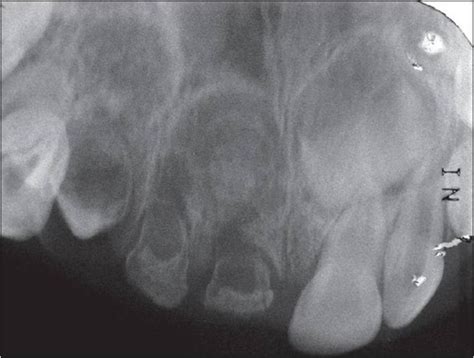 regional odontodysplasia Flashcards | Quizlet