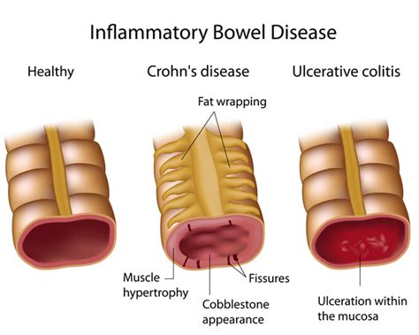 Ulcerative Colitis Medlineplus Genetics