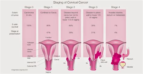 Cervical Cancer: Treatments