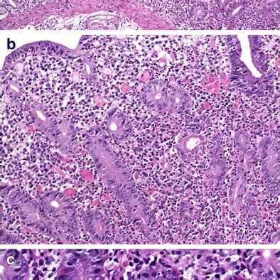 Involvement Of Ileum By Aie A Low Power View Of Ileal Biopsy Showing