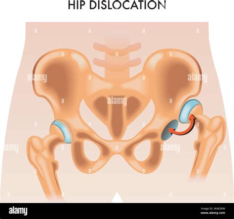 Dislocation Of The Hip Stock Vector Images Alamy