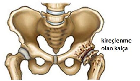 Kalça Eklemi Kireçlenmesi Kalça Kireçlenmesi Nedir DoktorTakvimi