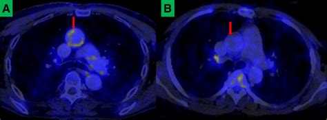 F Fdg Pet Ct Images Showing Axial Sections Through The Chest Of An