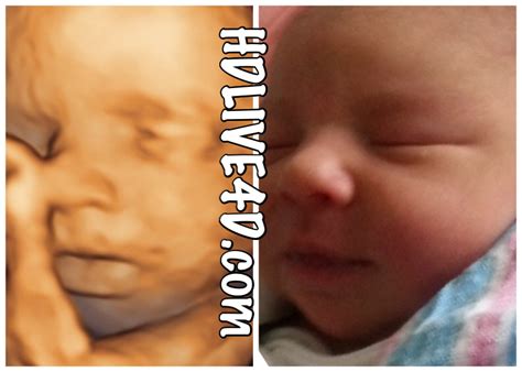 Before After Photo Gallery D Hdlive D D Hd Ultrasound Virginia