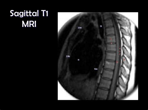 Sagittal T Mri Thoracic Spine Diagram Quizlet