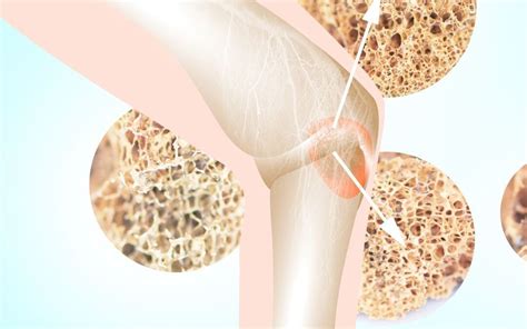 Qu Es La Osteoporosis Y Qu Podemos Hacer Egf Fisioterapia