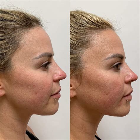 How To Reduce Swelling After Pdo Thread Lift